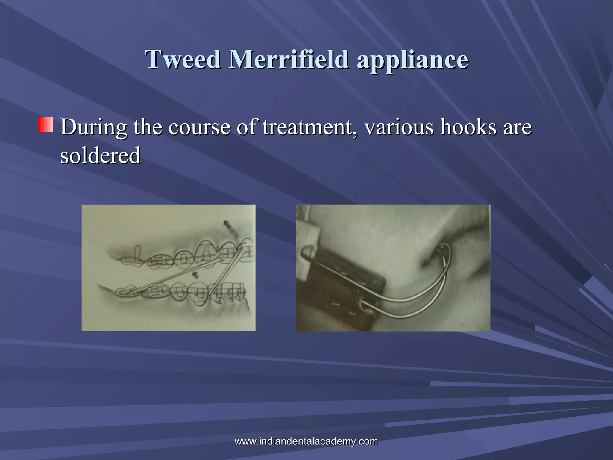 Tweed Merrifield appliance
During the course of treatment, various hooks are
soldered

www.indiandentalacademy.com

 