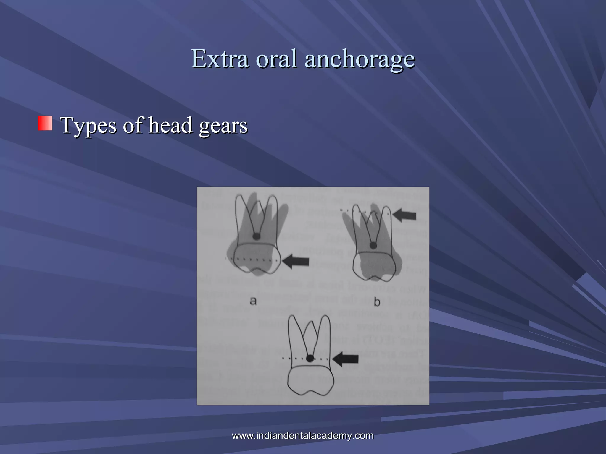 Extra oral anchorage
Types of head gears

www.indiandentalacademy.com

 