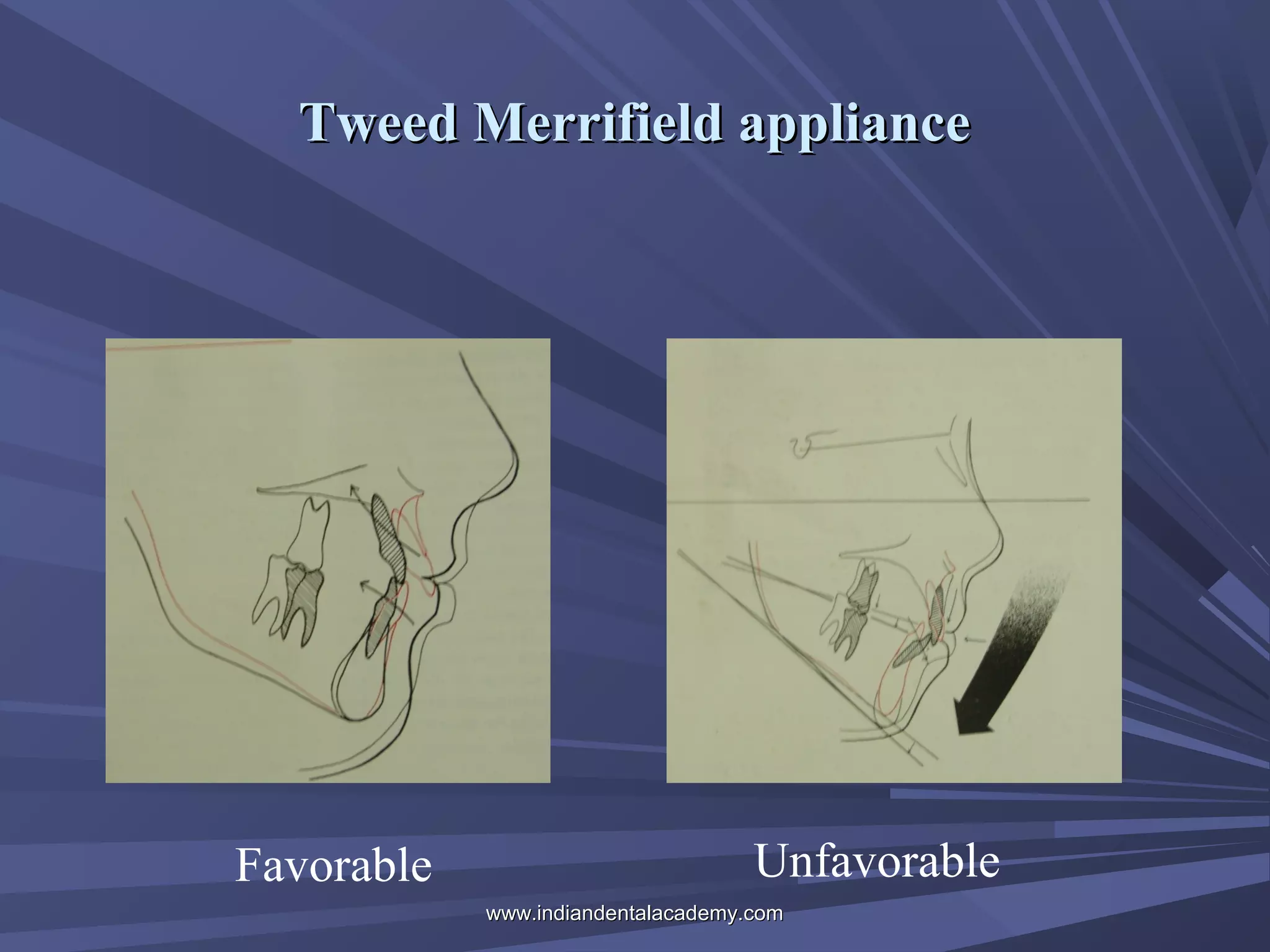 Tweed Merrifield appliance

Favorable

Unfavorable
www.indiandentalacademy.com

 