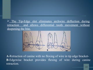 A
 
A-Retraction of canine with no flexing of wire in tip edge bracket-
B-Edgewise bracket provides flexing of wire during canine
retraction.
 The Tip-Edge slot eliminates archwire deflection during
retraction and allows differential tooth movement without
deepening the bite.
135
 
