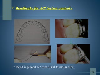  Bendbacks for A/P incisor control -
• Bend is placed 1-2 mm distal to molar tube.
142
 