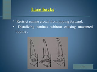  Restrict canine crown from tipping forward.
 Distalizing canines without causing unwanted
tipping .
Lace backs
143
 
