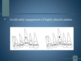  Avoid early engagement of highly placed canines .
150
 