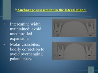 • Intercanine width
maintained: avoid
uncontrolled
expansion.
• Molar crossbites:
bodily correction to
avoid overhanging
palatal cusps.
Anchorage assessment in the lateral plane:
153
 