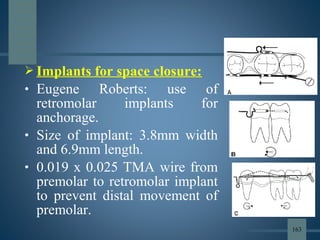  Implants for space closure:
• Eugene Roberts: use of
retromolar implants for
anchorage.
• Size of implant: 3.8mm width
and 6.9mm length.
• 0.019 x 0.025 TMA wire from
premolar to retromolar implant
to prevent distal movement of
premolar.
163
 