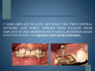  6MM IMPLANT PLACED BETWEEN THE TWO CENTRAL
INCISORS AND FORCE APPLIED WITH E-CHAIN FROM
IMPLANT TO THE MODIFIED RECTANGULAR DESIGN MADE
WITH 19X25 SS WIRE FOR PROTRACTION WITH INTRUSION .
183
 