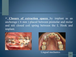  Closure of extraction spaces by implant as an
anchorage ( 6 mm ) placed between premolar and molar
and niti closed coil spring between the L Hook and
implant.
Lingual mechanics
184
 