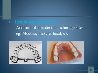 3. Reinforced anchorage:
Addition of non dental anchorage sites.
eg. Mucosa, muscle, head, etc.
26
 