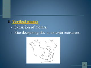 Vertical plane:
- Extrusion of molars,
- Bite deepening due to anterior extrusion.
52
 