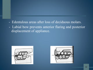 - Edentulous areas after loss of deciduous molars.
- Labial bow prevents anterior flaring and posterior
displacement of appliance.
62
 
