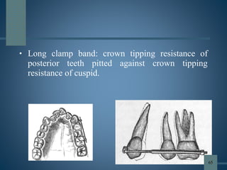 • Long clamp band: crown tipping resistance of
posterior teeth pitted against crown tipping
resistance of cuspid.
65
 