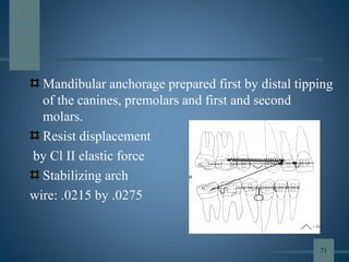 Mandibular anchorage prepared first by distal tipping
of the canines, premolars and first and second
molars.
Resist displacement
by Cl II elastic force
Stabilizing arch
wire: .0215 by .0275
71
 
