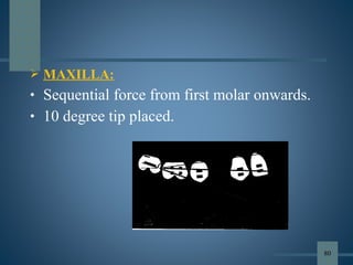  MAXILLA:
• Sequential force from first molar onwards.
• 10 degree tip placed.
80
 