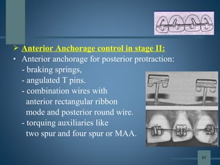  Anterior Anchorage control in stage II:
• Anterior anchorage for posterior protraction:
- braking springs,
- angulated T pins.
- combination wires with
anterior rectangular ribbon
mode and posterior round wire.
- torquing auxiliaries like
two spur and four spur or MAA.
97
 
