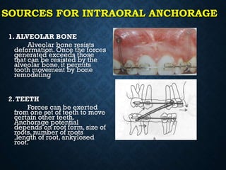 SOURCES FOR INTRAORAL ANCHORAGE
1. ALVEOLAR BONE
Alveolar bone resists
deformation. Once the forces
generated exceeds those
that can be resisted by the
alveolar bone, it permits
tooth movement by bone
remodeling
2.TEETH
Forces can be exerted
from one set of teeth to move
certain other teeth.
Anchorage potential
depends on root form, size of
roots, number of roots
,length of root, ankylosed
root.
 