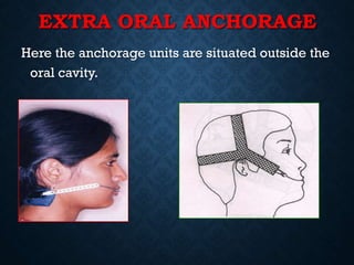 EXTRA ORAL ANCHORAGE
Here the anchorage units are situated outside the
oral cavity.
 
