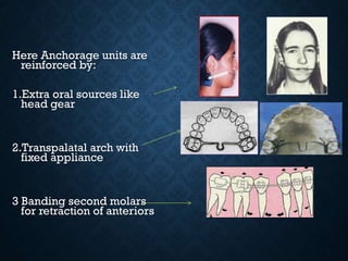 Here Anchorage units are
reinforced by:
1.Extra oral sources like
head gear
2.Transpalatal arch with
fixed appliance
3 Banding second molars
for retraction of anteriors
 