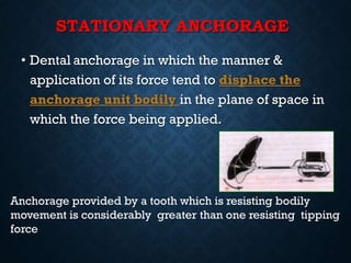 STATIONARY ANCHORAGE
• Dental anchorage in which the manner &
application of its force tend to displace the
anchorage unit bodily in the plane of space in
which the force being applied.
Anchorage provided by a tooth which is resisting bodily
movement is considerably greater than one resisting tipping
force
 