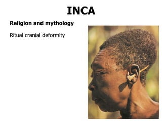 INCA Ritual cranial deformity Religion and mythology 