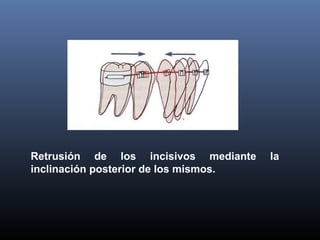 Retrusión de los incisivos mediante la
inclinación posterior de los mismos.
 
