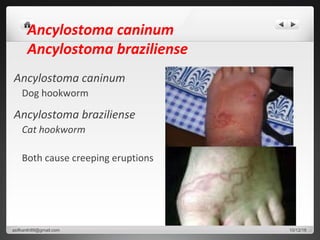 Ancylostoma caninum
Ancylostoma braziliense
Ancylostoma caninum
Dog hookworm
Ancylostoma braziliense
Cat hookworm
Both cause creeping eruptions
10/12/16asifkanth89@gmail.com
 
