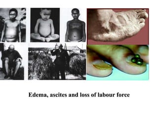 Edema, ascites and loss of labour force
 