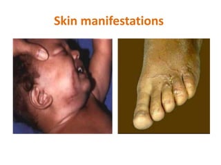 Skin manifestations
 