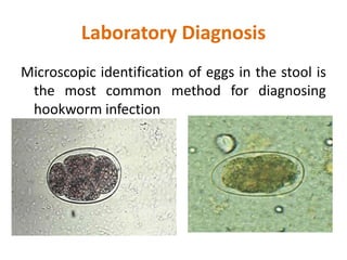 Laboratory Diagnosis
Microscopic identification of eggs in the stool is
the most common method for diagnosing
hookworm infection
 