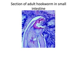 Section of adult hookworm in small
intestine
 