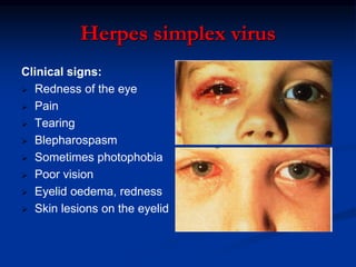 HIV/AIDS AND THE EYE DISORDERS IN ALL AGE GROUP | PPT