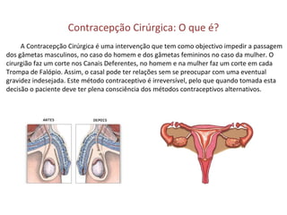 Contracepção Cirúrgica: O que é?
A Contracepção Cirúrgica é uma intervenção que tem como objectivo impedir a passagem
dos gâmetas masculinos, no caso do homem e dos gâmetas femininos no caso da mulher. O
cirurgião faz um corte nos Canais Deferentes, no homem e na mulher faz um corte em cada
Trompa de Falópio. Assim, o casal pode ter relações sem se preocupar com uma eventual
gravidez indesejada. Este método contraceptivo é irreversível, pelo que quando tomada esta
decisão o paciente deve ter plena consciência dos métodos contraceptivos alternativos.
 