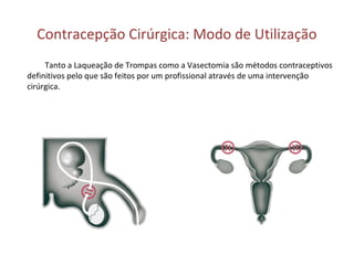 Contracepção Cirúrgica: Modo de Utilização
Tanto a Laqueação de Trompas como a Vasectomia são métodos contraceptivos
definitivos pelo que são feitos por um profissional através de uma intervenção
cirúrgica.
 