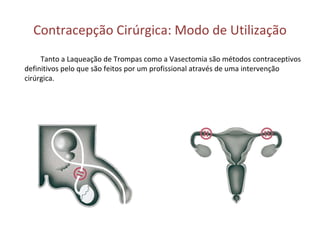 Contracepção Cirúrgica: Modo de Utilização Tanto a Laqueação de Trompas como a Vasectomia são métodos contraceptivos definitivos pelo que são feitos por um profissional através de uma intervenção cirúrgica. 