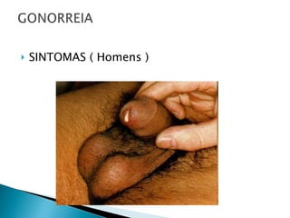 SINTOMAS ( Homens ) 