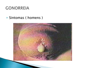 Sintomas ( homens ) 