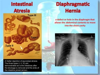 Gastrointestinal Tract Diseases | PPTX