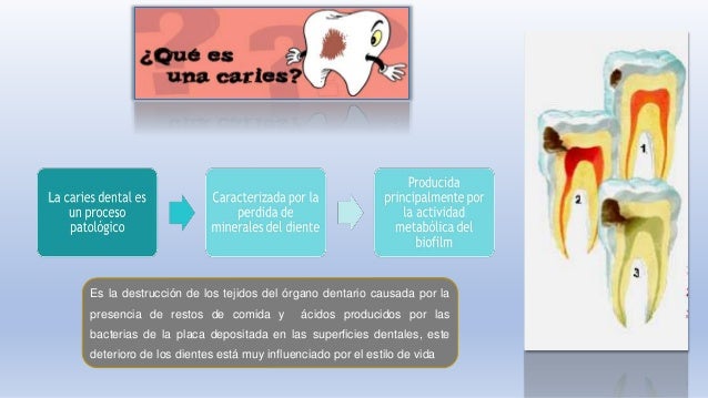 Etiología de la caries dental