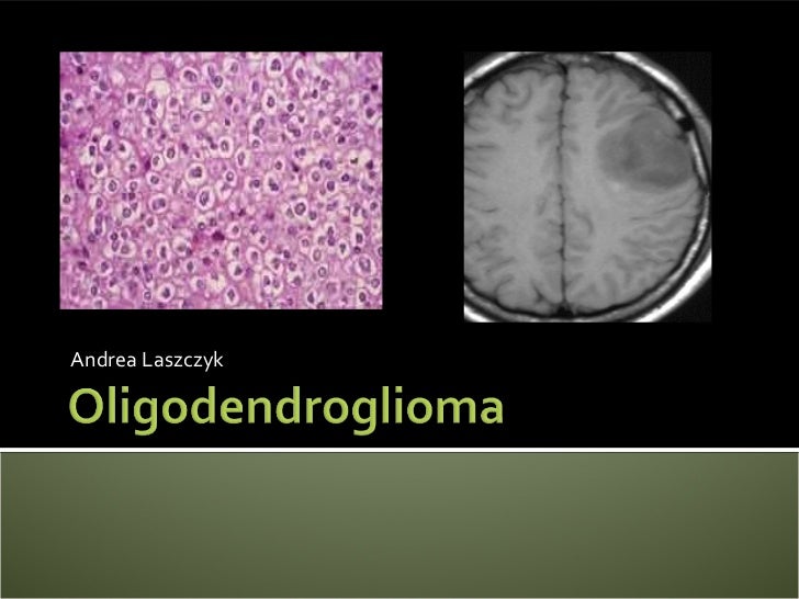 Andrea Oligodendroglioma