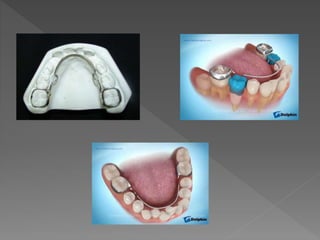 Puede tener diferentes aplicaciones:
Fijar los maxilares de modo que se evite el
desplazamiento de los dientes hacia la lí...