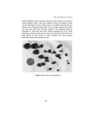 The Amazing Liver Cleanse
105
health problems, and to prevent diseases from arising, you need to
remove all the stones. This may require at least six cleanses which
can be performed at two to three-week or monthly intervals (do not
cleanse more frequently than that). If you cannot cleanse this often,
you may take more time between cleanses. The important thing to
remember is that once you have started cleansing the liver, keep
cleansing it until no more stones come out. Leaving it half clean for a
long period of time (three or more months) can cause greater
discomfort than not cleansing it at all.
Figure 13a: Green-colored gallstones
 