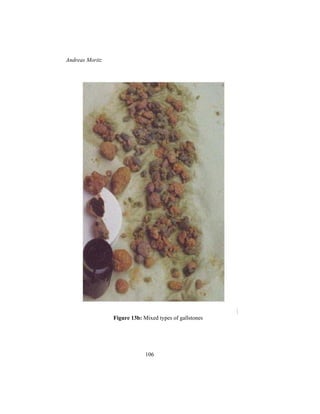 Andreas Moritz
106
Figure 13b: Mixed types of gallstones
 