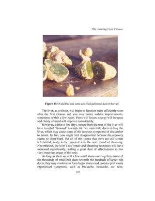 The Amazing Liver Cleanse
107
Figure 13c: Calcified and semi-calcified gallstones (cut in halves)
The liver, as a whole, will begin to function more efficiently soon
after the first cleanse and you may notice sudden improvements,
sometimes within a few hours. Pains will lessen, energy will increase
and clarity of mind will improve considerably.
However, within a few days, stones from the rear of the liver will
have traveled ‘forward’ towards the two main bile ducts exiting the
liver, which may cause some of the previous symptoms of discomfort
to return. In fact, you might feel disappointed because the recovery
seems so short-lived. But all of this shows that there are still stones
left behind, ready to be removed with the next round of cleansing.
Nevertheless, the liver’s self-repair and cleansing responses will have
increased significantly, adding a great deal of effectiveness to this
very important organ of the body.
As long as there are still a few small stones moving from some of
the thousands of small bile ducts towards the hundreds of larger bile
ducts, they may combine to form larger stones and produce previously
experienced symptoms, such as backache, headache, ear ache,
 