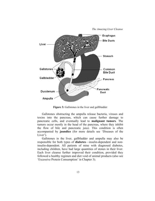 The Amazing Liver Cleanse
13
Figure 3: Gallstones in the liver and gallbladder
Gallstones obstructing the ampulla release bacteria, viruses and
toxins into the pancreas, which can cause further damage to
pancreatic cells, and eventually lead to malignant tumors. The
tumors occur mostly in the head of the pancreas, where they inhibit
the flow of bile and pancreatic juice. This condition is often
accompanied by jaundice (for more details see ‘Diseases of the
Liver’).
Gallstones in the liver, gallbladder and ampulla may also be
responsible for both types of diabetes—insulin-dependent and non-
insulin-dependent. All patients of mine with diagnosed diabetes,
including children, have had large quantities of stones in their liver.
Each liver cleanse further improved their condition, provided they
followed a healthy regimen and diet void of animal products (also see
‘Excessive Protein Consumption’ in Chapter 3).
 