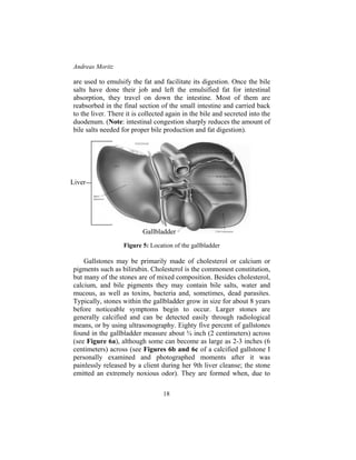 Andreas Moritz
18
are used to emulsify the fat and facilitate its digestion. Once the bile
salts have done their job and left the emulsified fat for intestinal
absorption, they travel on down the intestine. Most of them are
reabsorbed in the final section of the small intestine and carried back
to the liver. There it is collected again in the bile and secreted into the
duodenum. (Note: intestinal congestion sharply reduces the amount of
bile salts needed for proper bile production and fat digestion).
Figure 5: Location of the gallbladder
Gallstones may be primarily made of cholesterol or calcium or
pigments such as bilirubin. Cholesterol is the commonest constitution,
but many of the stones are of mixed composition. Besides cholesterol,
calcium, and bile pigments they may contain bile salts, water and
mucous, as well as toxins, bacteria and, sometimes, dead parasites.
Typically, stones within the gallbladder grow in size for about 8 years
before noticeable symptoms begin to occur. Larger stones are
generally calcified and can be detected easily through radiological
means, or by using ultrasonography. Eighty five percent of gallstones
found in the gallbladder measure about ¾ inch (2 centimeters) across
(see Figure 6a), although some can become as large as 2-3 inches (6
centimeters) across (see Figures 6b and 6c of a calcified gallstone I
personally examined and photographed moments after it was
painlessly released by a client during her 9th liver cleanse; the stone
emitted an extremely noxious odor). They are formed when, due to
Gallbladder
Liver
 