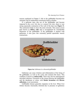 The Amazing Liver Cleanse
19
reasons explained in Chapter 3, bile in the gallbladder becomes too
saturated, and its unabsorbed constituents begin to harden.
If a gallstone does slip out of the gallbladder and become
impacted in the cystic bile duct or common bile duct, there is very
strong spasmodic contraction of the wall of the duct (see Figure 3).
The contraction helps to move the stone onwards. This causes severe
pain known as biliary colic and is accompanied by considerable
distension of the gallbladder. If the gallbladder is packed with
gallstones, it also goes into extremely painful spasmodic muscle
contractions.
Figure 6a: Gallstones in a dissected gallbladder
Gallstones can cause irritation and inflammation of the lining of
the gallbladder, as well as the cystic and common bile ducts. This
condition is known as cholecystitis. There may also be superimposed
microbial infection. Ulceration of the tissues between the gallbladder
and the duodenum or colon, with fistula formation and fibrous
adhesions, is not uncommon.
Gallbladder disease generally originates in the liver. When liver
lobules become structurally distorted due to presence of gallstones
 