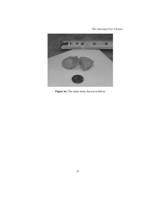 The Amazing Liver Cleanse
21
Figure 6c: The same stone, but cut in halves
 