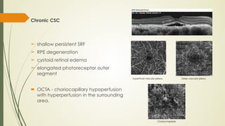 Andreea moraru pachychoroid spectrum of diseases | PDF