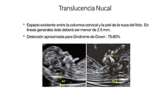 TranslucenciaNucal
• Espacioexistente entre la columna cervical y la piel de la nucadel feto. En
líneas generales éste deberá sermenor de 2.5mm.
• Detección aproximada paraSíndrome de Down : 75-80%
 