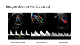 Imagen doppler (varios vasos)
Arteria Cerebral media Arteria Umbilical Ductus venoso
Pico sistolico
Fin de la diástole
 