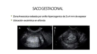 SACOGESTACIONAL
• ZonaAneocoica rodeada por anillo hipercogenico de 2a4 mm de espesor
• Ubicación excéntrica en elfondo
 